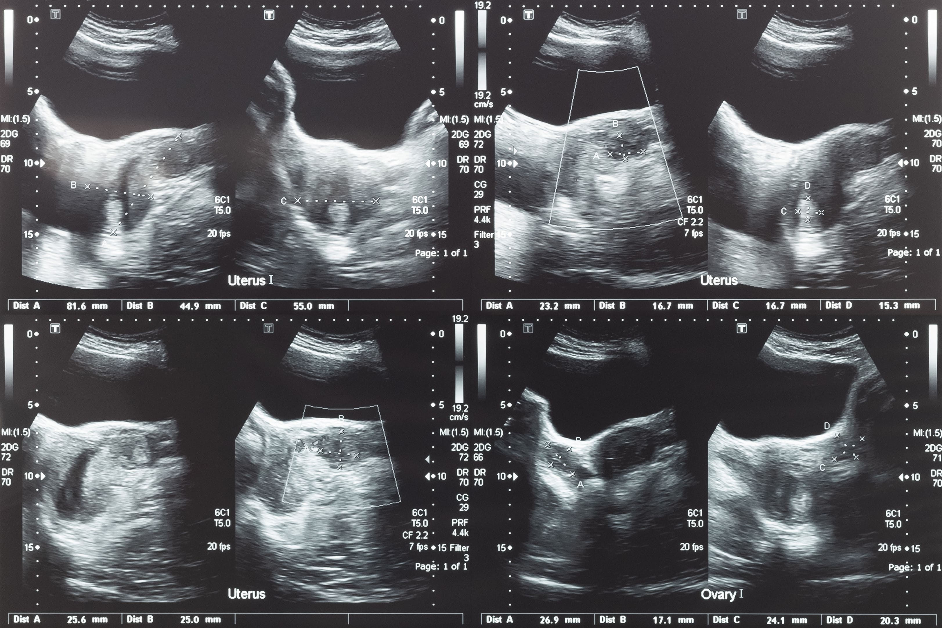Imagem mostra como o mioma uterino se desenvolve